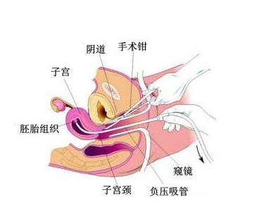 微管無痛人流_無痛人流_無痛人流卡