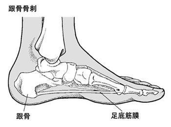 它是骨质增生症的一种,其症状是足根压痛,脚底疼痛,早晨重,下午轻