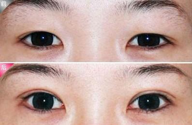 外眦韧带固定术