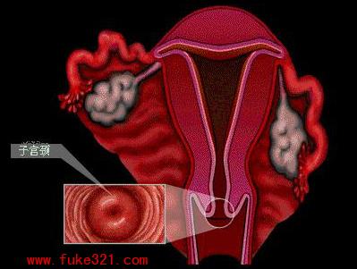 宫颈闭锁图片图片