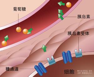 胰岛素瘤