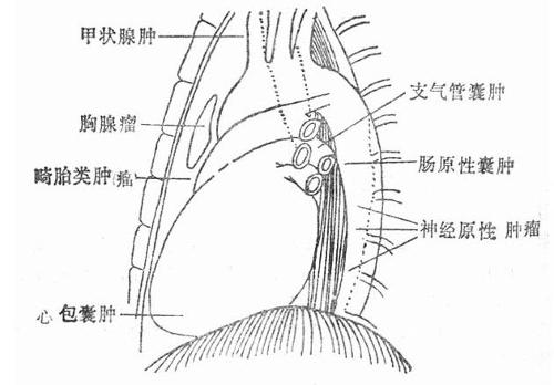 儿童纵隔肿瘤图片