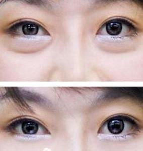 经过眼内结膜的切口,把过度鼓出的脂肪吸出,吸取眼袋的同时避开细小血