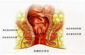 小肠瘘 - 搜狗百科
