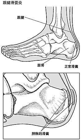 跖趾关节痛