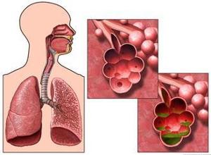 肺气肿是什么引起的图片