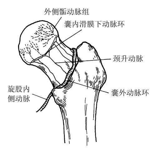 股骨颈骨折分型解剖图图片