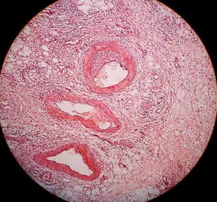 變應性血管炎(allergic vasculitis)是比較常見的一種疾病,其組織