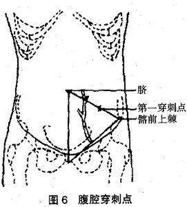 腹膜腔穿刺术 