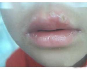 口炎