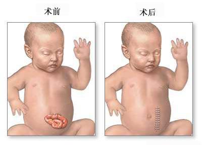 腹裂