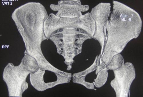 女性骨盆耻骨骨折图片