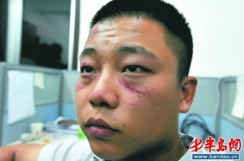 记者被打后脸部伤痕累累