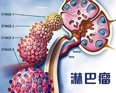 淋巴瘤