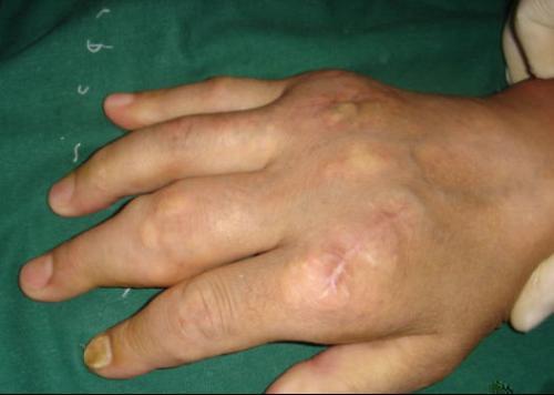 手指尿酸结晶初期图片图片