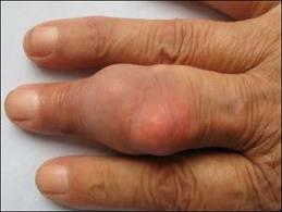 2指关节骨性关节炎1,类风湿性关节炎,常为手指的近端指关节受累,有