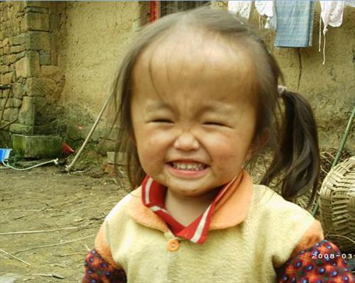 先天性脑积水 先天性脑积水