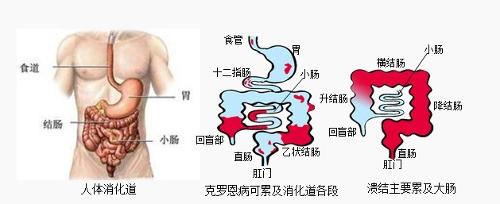 溃疡性结肠炎