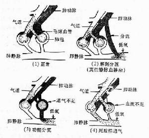 急性呼吸衰竭