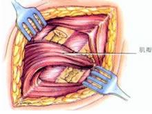 干酪型胸壁结核病灶清除手术后多久才能消肿?
