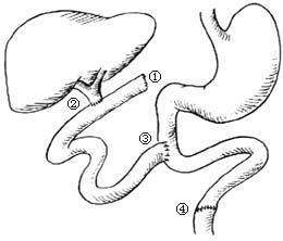 编辑2治疗方法胆道炎症以胆管炎症为主者称胆管炎(cholangitis),以