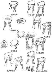 先天性二尖瓣畸形瓣膜病变整复术