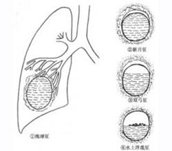 肺包虫囊肿破裂图片图片