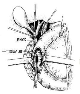 胰腺囊肿