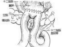 胰腺囊肿