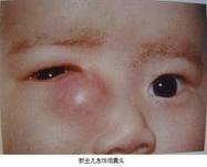 急性泪囊炎