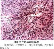 胃平滑肌肉瘤