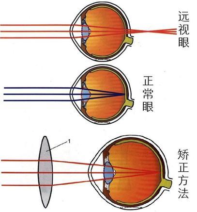 远视眼