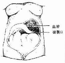腹膜后血肿