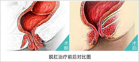 肛肠脱垂