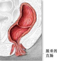 女性直肠脱垂图片