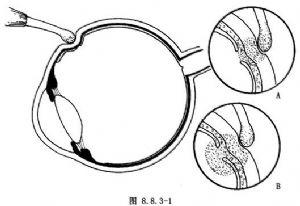 原发性视网膜脱离-冷冻疗法