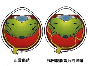 原发性视网膜脱离