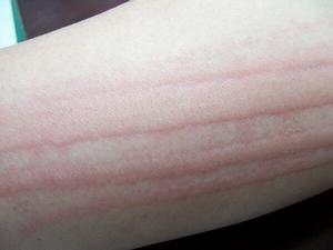 皮肤划痕症 搜狗百科