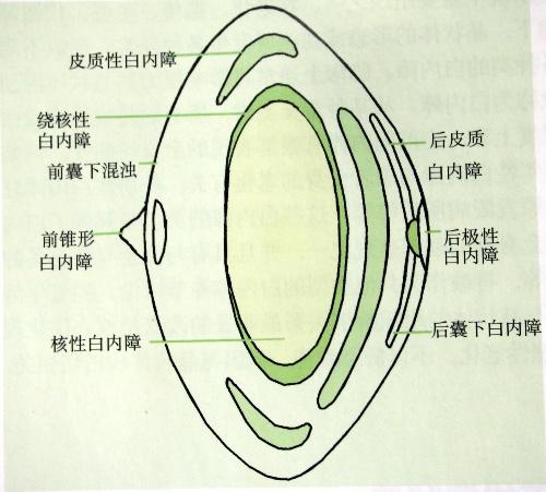 白内障示意图图片