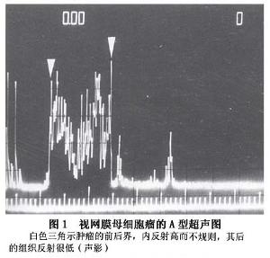 视网膜母细胞瘤