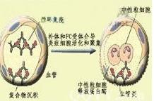 Ⅲ型超敏反应性疾病 - 搜狗百科