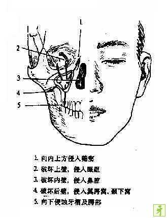 上頜竇惡性腫瘤