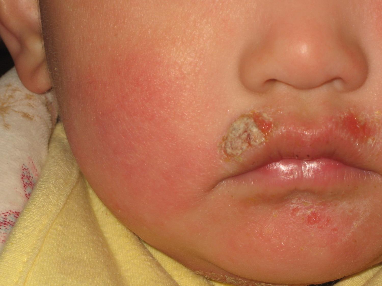 婴儿水痘初期症状图片（又一网红宝宝霜出事了）-幼儿百科-魔术铺