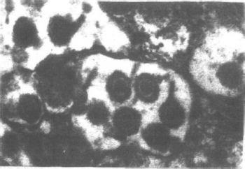 痘疮 - 搜狗百科