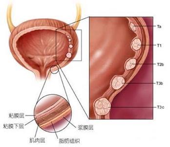 膀胱移行細胞癌是泌尿系統最常見的腫瘤,佔男性腫瘤的6%,死亡率的2.