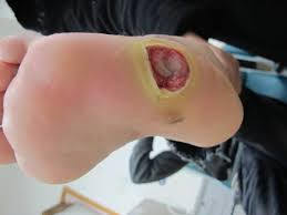 足底溃疡