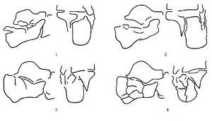 图6——跟骨关节型骨折