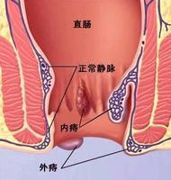 静脉曲张性外痔