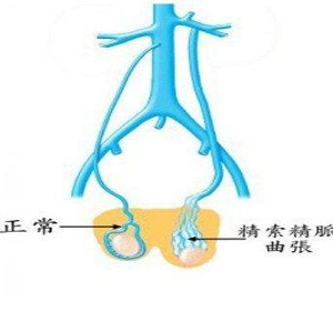 部位无痛性阴囊内肿块常见症状泌尿外科就诊科室精索肿瘤包括由输精管