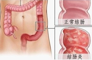 结肠炎图片